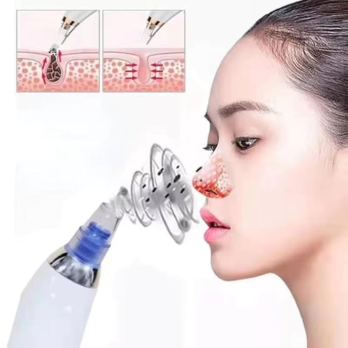 Blackhead Remover Extractor